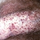 Fabry's Disease Fabry's Disease