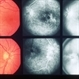 Inflammation Inflammation