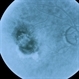 Dry Macular Scar With Recurrence Dry Macular Scar With Recurrence