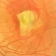 Fibrous Macular Scar With Hemorrhage Fibrous Macular Scar With Hemorrhage