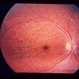 Reticular Pattern Dystrophy