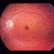 Reticular Pattern Dystrophy