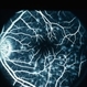 Fleck Retinopathy With Dark Choroid Stargardt Fleck Retinopathy With Dark Choroid Stargardt