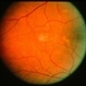 Multiple Vitelliforn Retinal 5