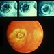 Macular Staphyloma With FA