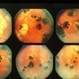 Inflammation Inflammation