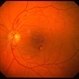 Hypertensive Retinopathy Hypertensive Retinopathy