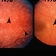 Fleck Retinopathy Fleck Retinopathy
