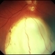 Coloboma Coloboma