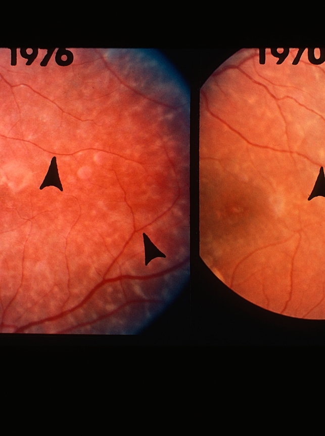 Flecks Rettine Was Ist Der Gelbe Fleck In Der Retina? – UPAXBI