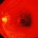 Central Pigment Changes