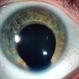 Iris Coloboma Iris Coloboma
