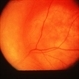 Choroidal Osteoma Or Hemangioma Choroidal Osteoma Or Hemangioma