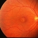 Cone Dystrophy Cone Dystrophy