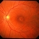 Cone Dystrophy Cone Dystrophy