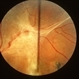Von Hippel Angioma