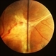 Von Hippel Angioma