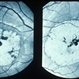 Red-Free Photos Of Macular Atrophy Of Staphyloma Red-Free Photos Of Macular Atrophy Of Staphyloma
