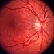 Vascular Tortousity Vascular Tortousity
