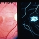 Stargardt's With Dark Choroid Stargardt's With Dark Choroid