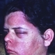 Herpes Zoster
