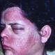 Herpes Zoster