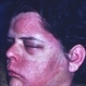 Herpes Zoster