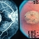 Macular Atrophy Macular Atrophy