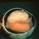 Retinoblastoma Retinoblastoma