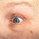 Bilateral Retinal Detachments With Bilateral Phthisis