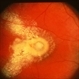 Retinal Angioma With Lipid In The Fovea Retinal Angioma With Lipid In The Fovea