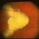 Retinal Angioma With Lipid In The Fovea Retinal Angioma With Lipid In The Fovea