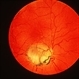 Coloboma Of The Optic Nerve, Possible A Copy Of A Drawing Coloboma Of The Optic Nerve, Possible A Copy Of A Drawing