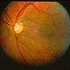 Multiple Vitelliforn Retinal 6