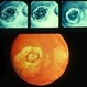 Macular Staphyloma With FA