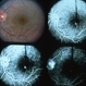 Inflammation Inflammation