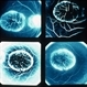 Macular Atrophy With Staphyloma FA Macular Atrophy With Staphyloma FA