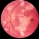 Purtcsher's Retinopathy Purtcsher's Retinopathy