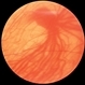 Vortex Vein In A Patient With A Blond Fundus Vortex Vein In A Patient With A Blond Fundus