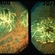 Macular Atrophy With Staphyloma FA Macular Atrophy With Staphyloma FA