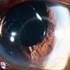 Anterior Intraocular Lens Anterior Intraocular Lens