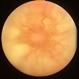 Funnel Retinal Detachment With Proliferative Vitreoretinopathy Funnel Retinal Detachment With Proliferative Vitreoretinopathy