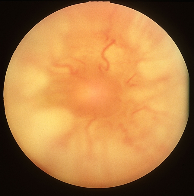 Funnel Retinal Detachment With Proliferative Vitreoretinopathy Retina