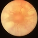 Funnel Retinal Detachment With Proliferative Vitreoretinopathy Funnel Retinal Detachment With Proliferative Vitreoretinopathy