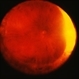 Retinal Detachment Repaired With Scleral Buckle Retinal Detachment Repaired With Scleral Buckle