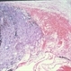 Epiretinal Membrane, ERM, Dry Macular Degeneration Epiretinal Membrane, ERM, Dry Macular Degeneration