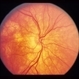 Pattern Dystrophy