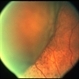 Choroidal  Detachment Choroidal  Detachment