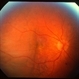 Choroidal Detachment Choroidal Detachment