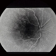 Pattern Dystrophy